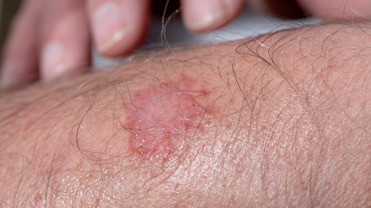 Rashes types warning signs ignore never should these ringworm