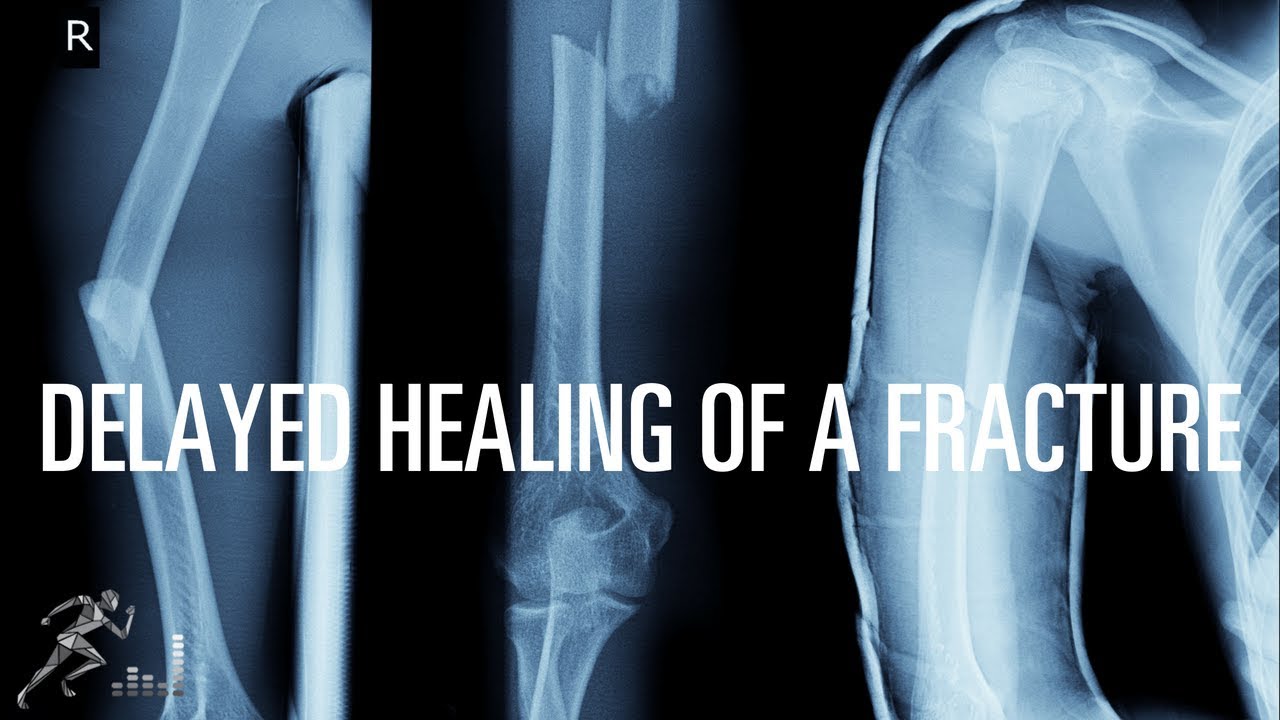 Bone fractures open pain fracture closed management options bones fractured treatment gif anatomy dislocation