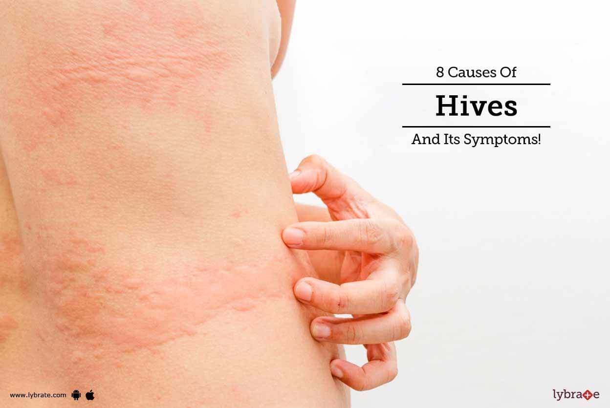 Hives symptoms urticaria causes skin diagnosis steadyhealth irritations