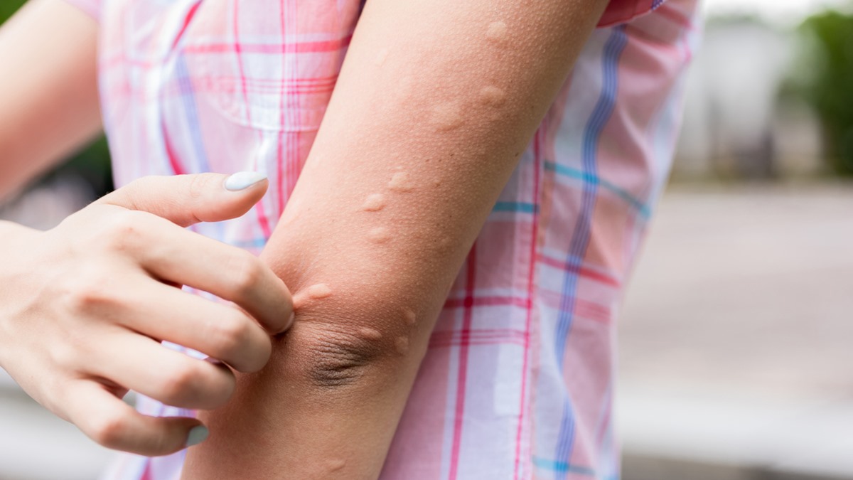 Urticaria fibromyalgia hives rash itching chronic symptoms pain linked