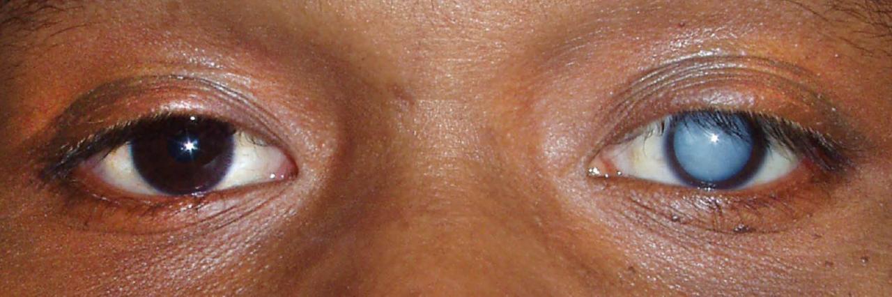 Cataract cataracts drops after cataratas myopia pupil dissolve pathology catarata fuss scientists eyesite noun kleyn opticians optometrist