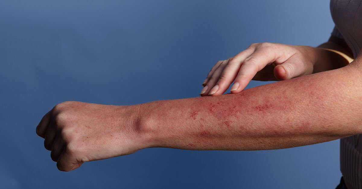 Hives allergic reaction caused causes prevention healthline