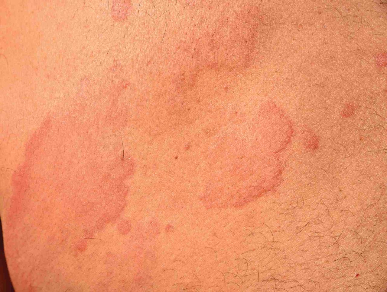 Hives indicate intolerance