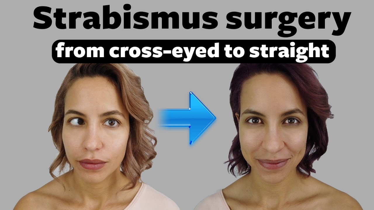 Strabismus eye crossed exercises draxe resolve ways axe