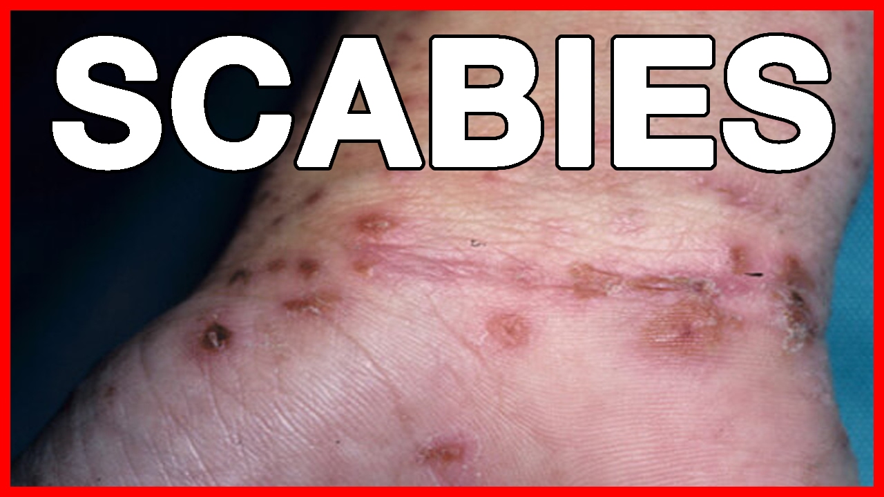 Scabies quickly