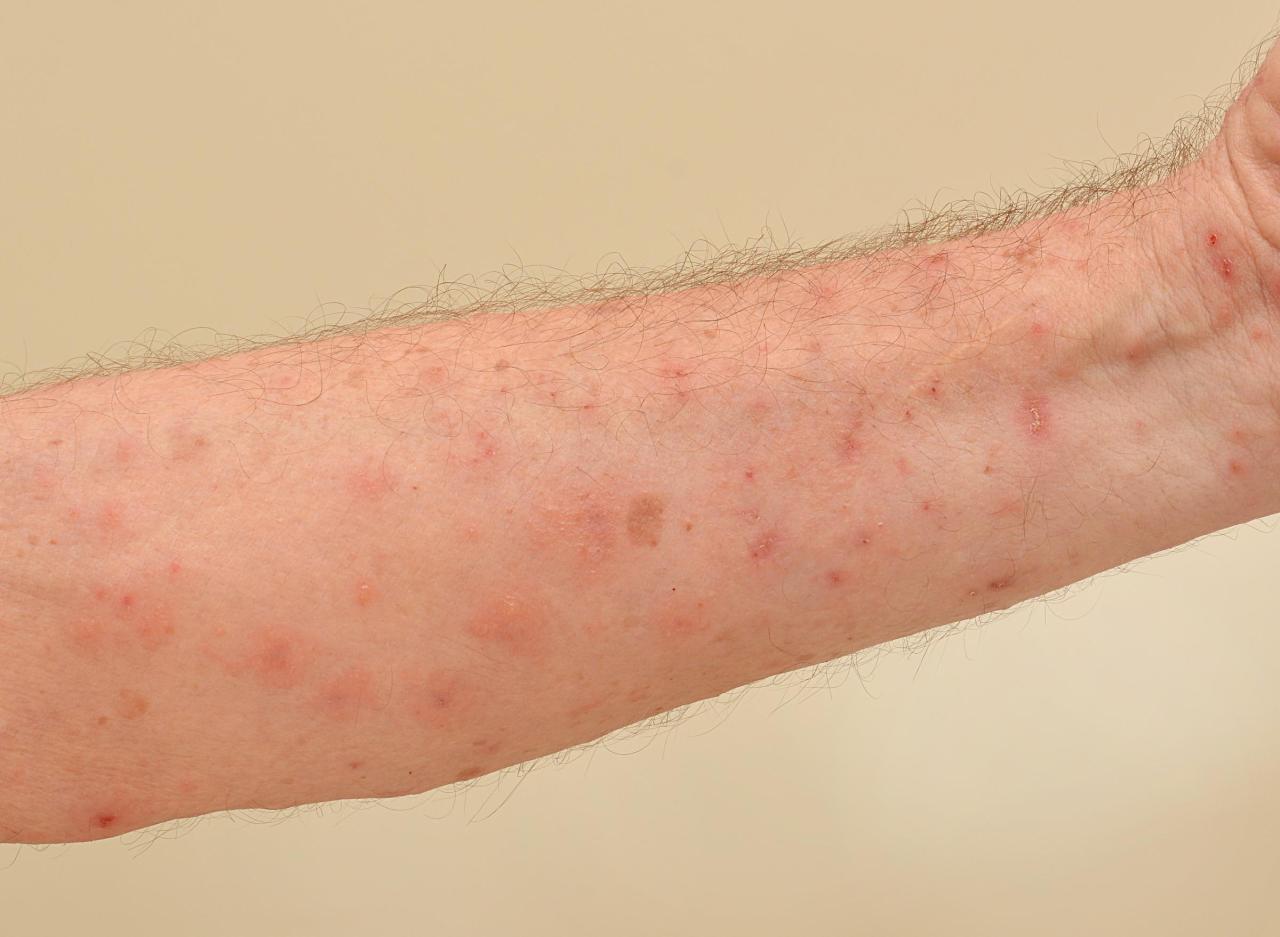 Scabies crusted symptoms treatment signs cure