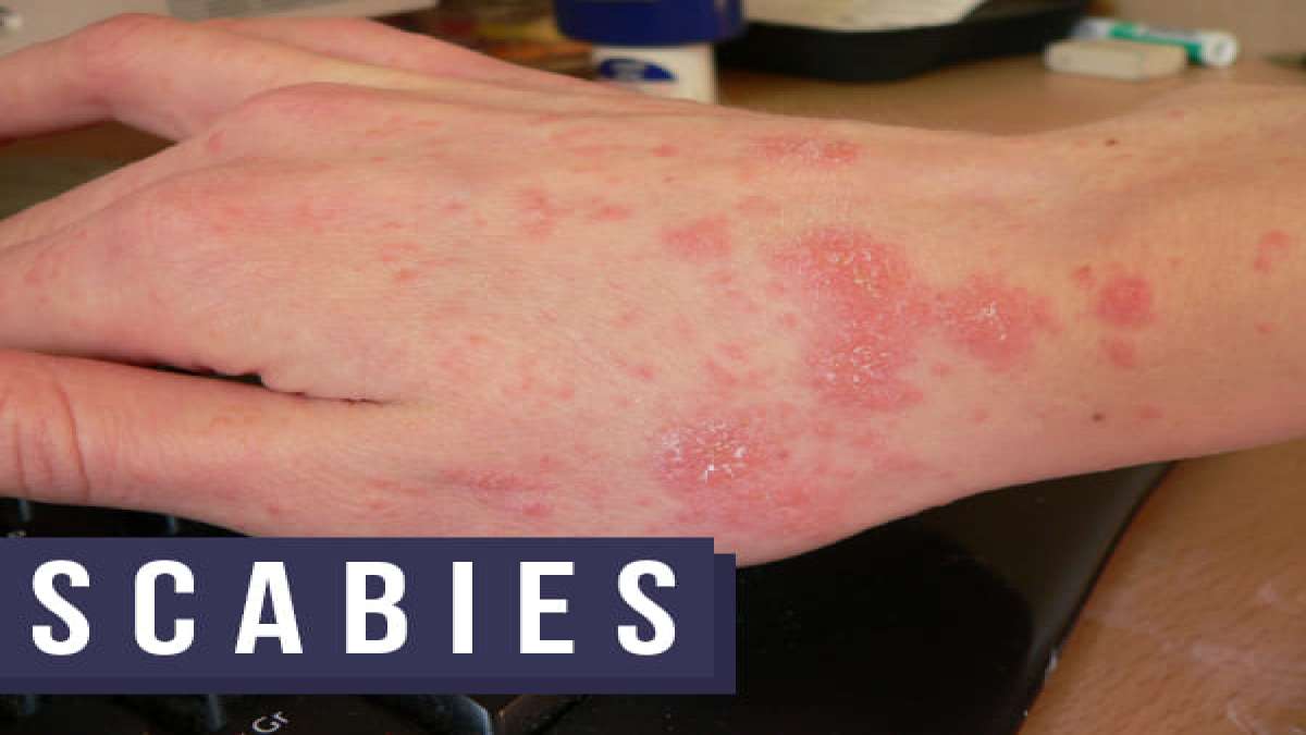 Scabies caused cure they