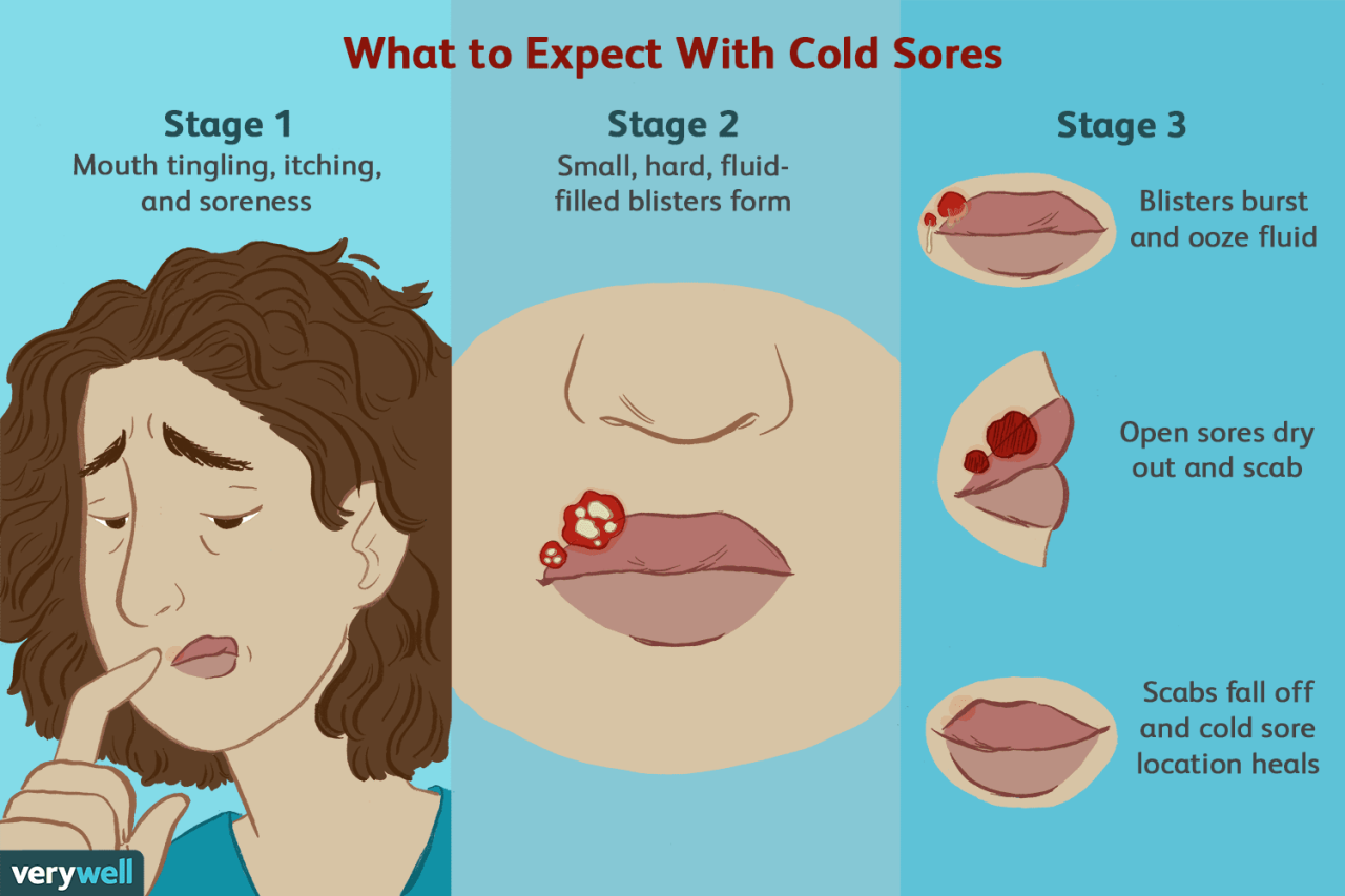 Cold sore lip stages sores treatment mouth fever blisters signs remedies rid canker herpes blister healing visible reduce lips red